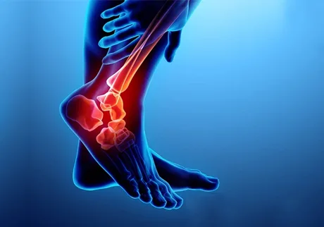 Ankle-Sprain