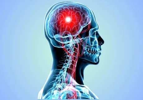 Neurological Conditions