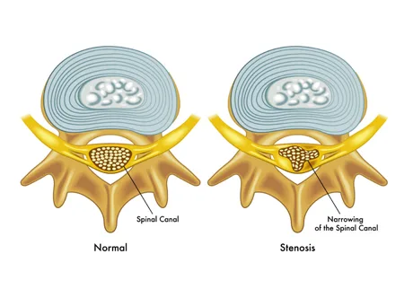Spinal-Canal-Stenosis