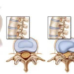 stenosis