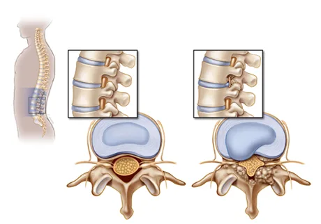 stenosis