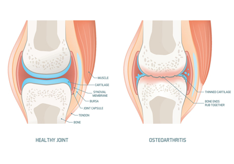 Osteoarthritis