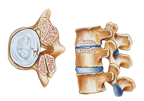 Stenosis-1