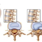 stenosis